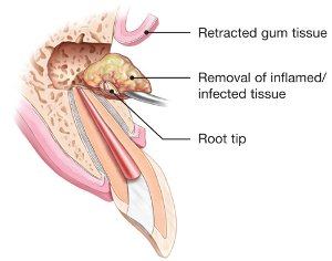 Diagram of gum tissue retracted to remove infected tissue at the root tip