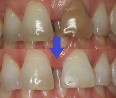 Before and after photo of a darkened, root-canaled tooth restored to a natural matching shade with internal bleaching