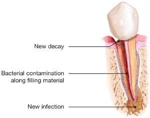 Diagram showing an untreated calcified canal where infection has not healed after a prior root canal