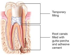 Diagram of root canals filled with gutta-percha and adhesive cement, sealed beneath a temporary filling