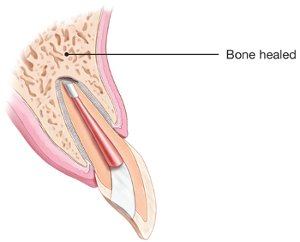 Diagram of bone healed around the root tip after surgery