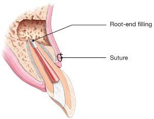 Diagram of a root-end filling placed and the gum sutured